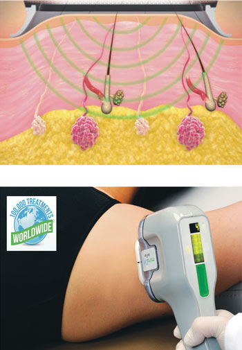 how miradry functions