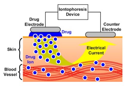 iontophoresis diagram